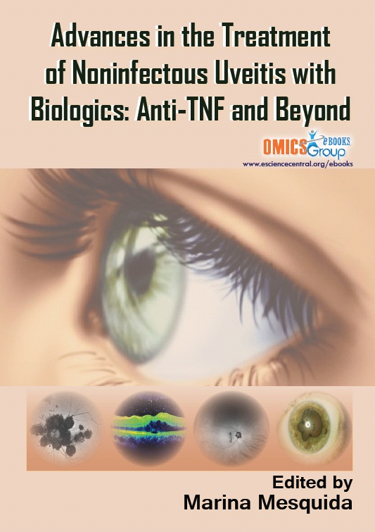 Advances in the Treatment of Noninfectious Uveitis with Biologics: Anti-TNF and Beyond